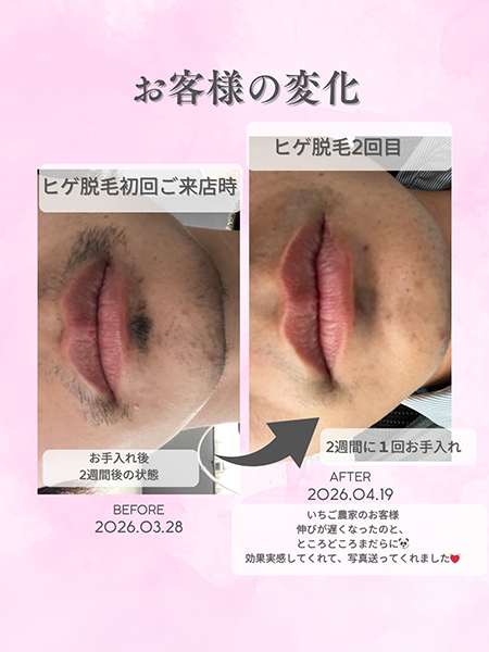 ヒゲ脱毛の症例写真
