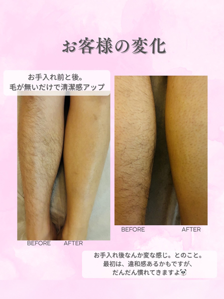 ひざ下脱毛の症例写真
