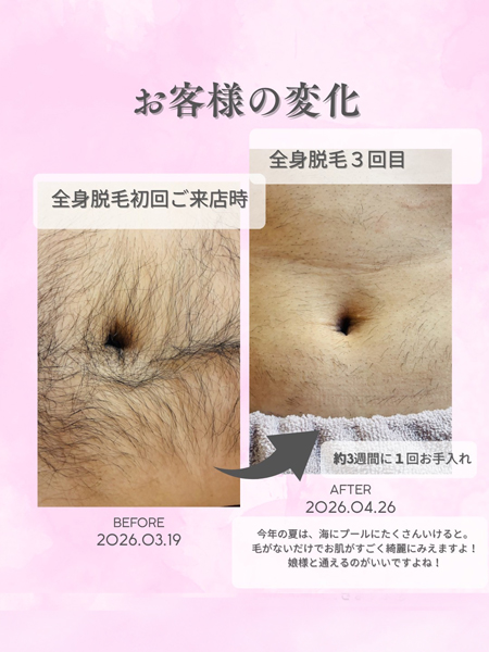 ボディ脱毛の症例写真